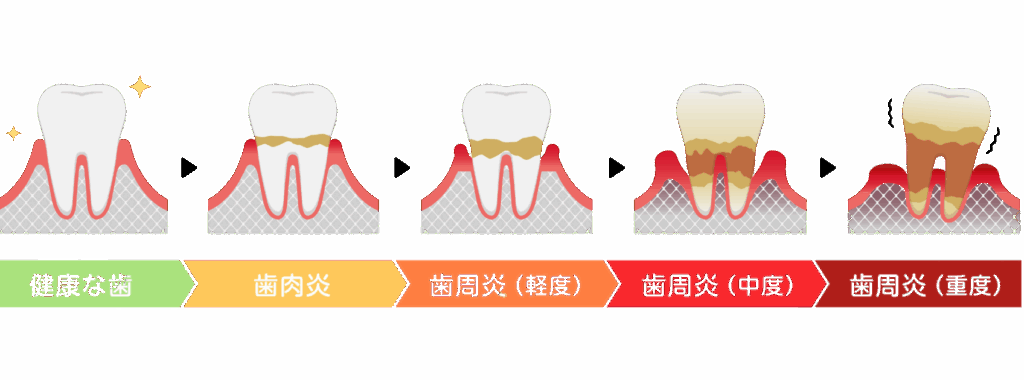 歯周病の進行|自由が丘駅前歯医者