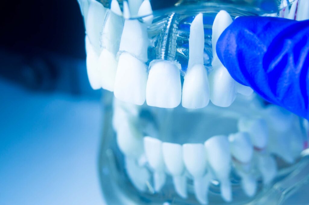 前歯の入れ歯以外の選択肢であるインプラント