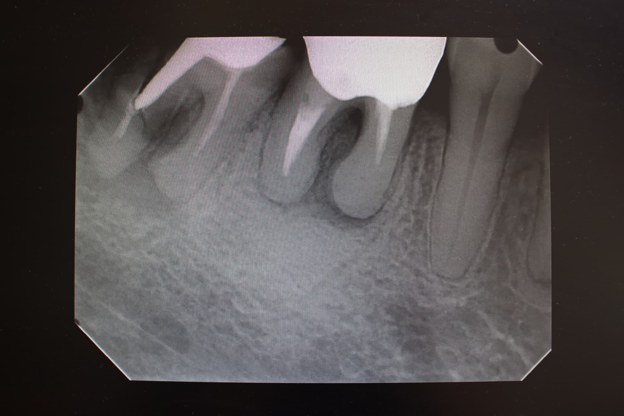 根管治療している歯のレントゲン写真