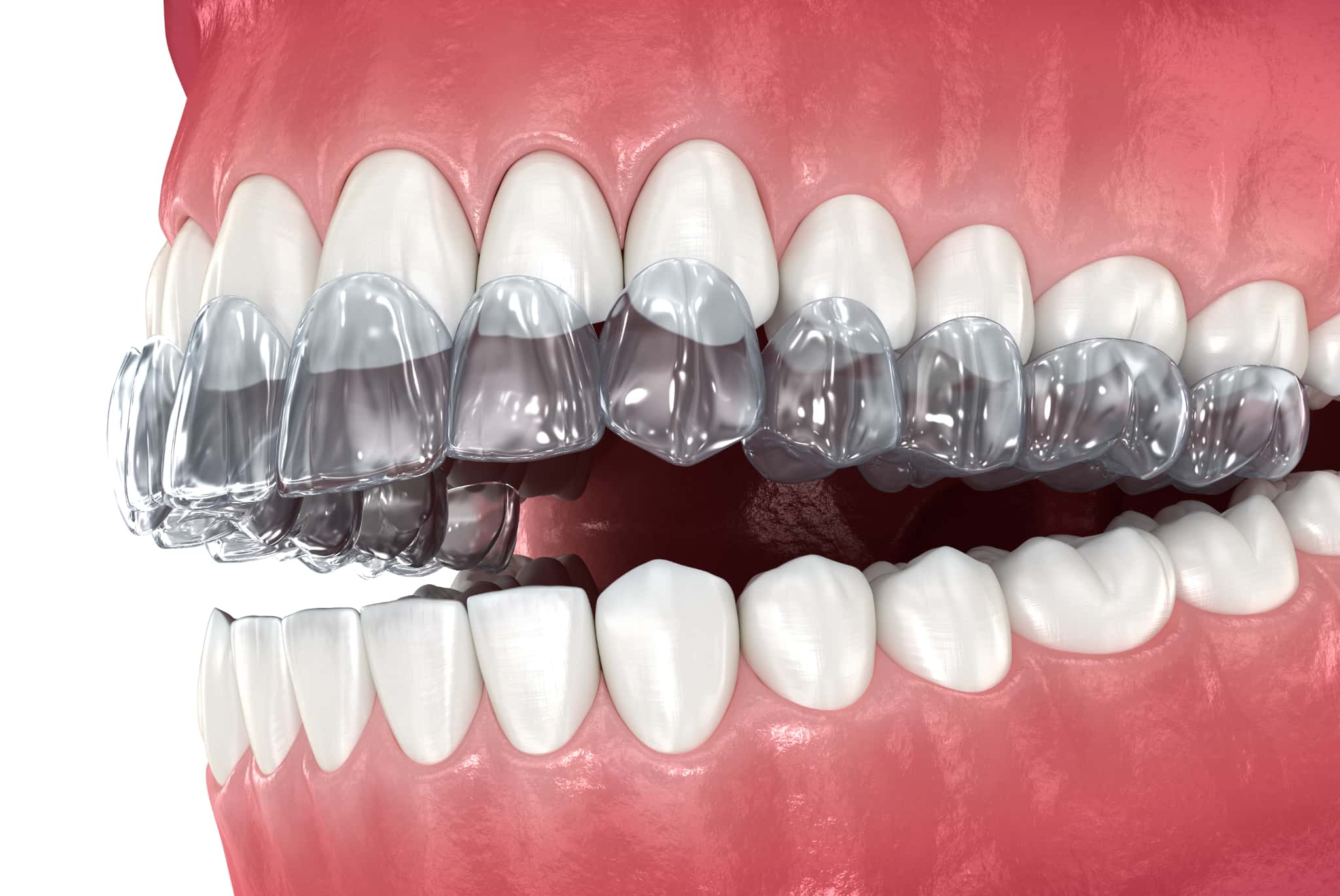 インビザラインを歯に装着するイメージ