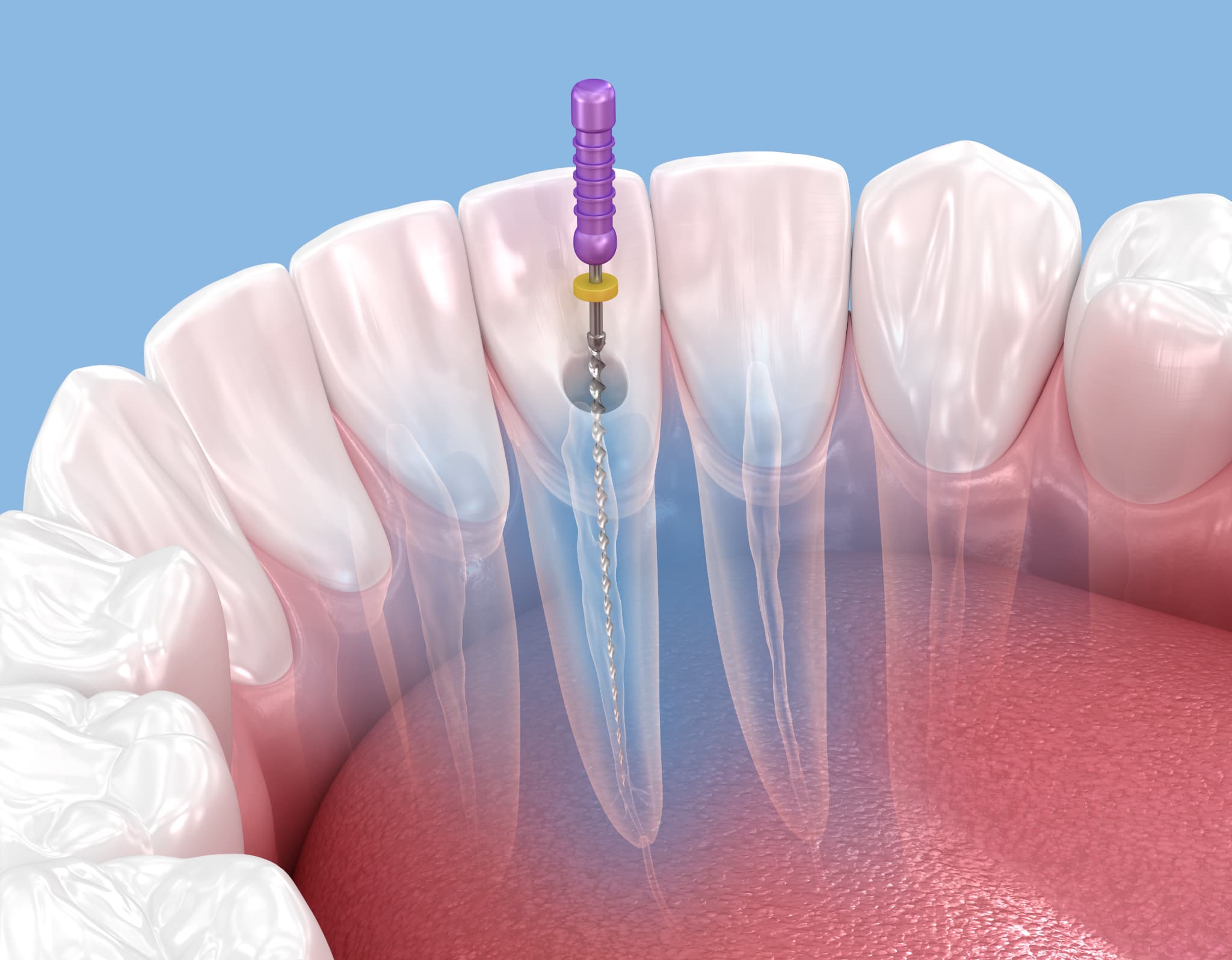 根管治療のイメージ