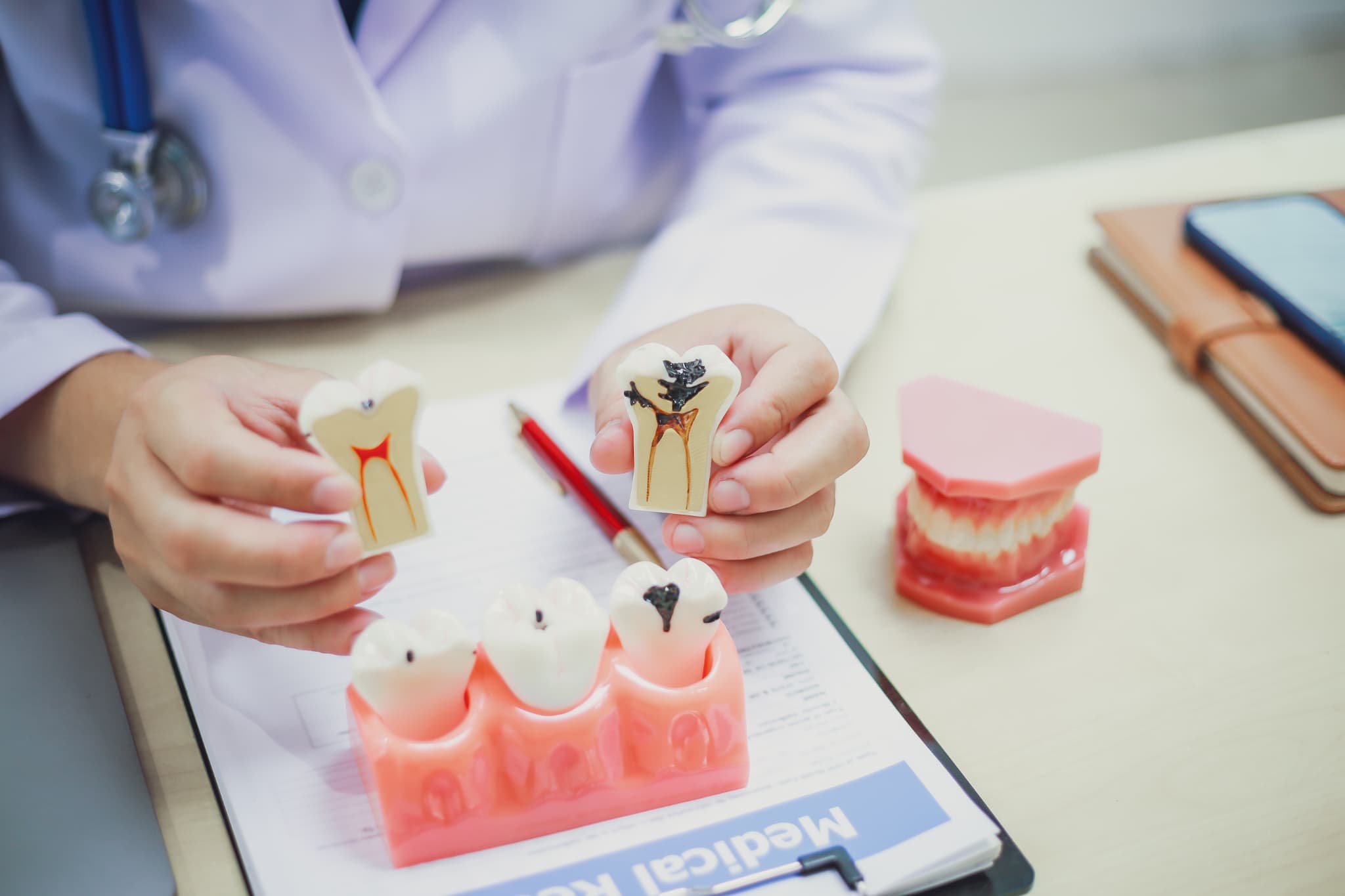 健康な歯の模型と虫歯が進行した歯の模型で根管治療について説明する歯科医師の手元