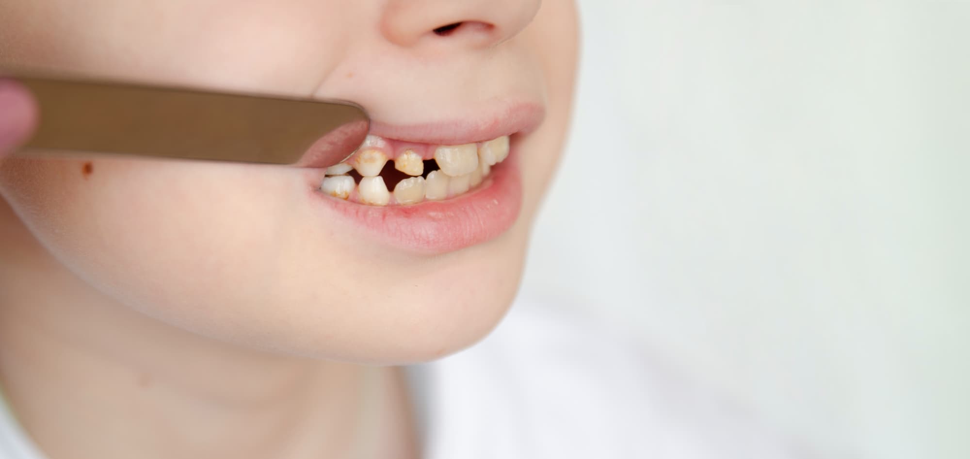 歯並びが悪いため虫歯になりやすい子ども