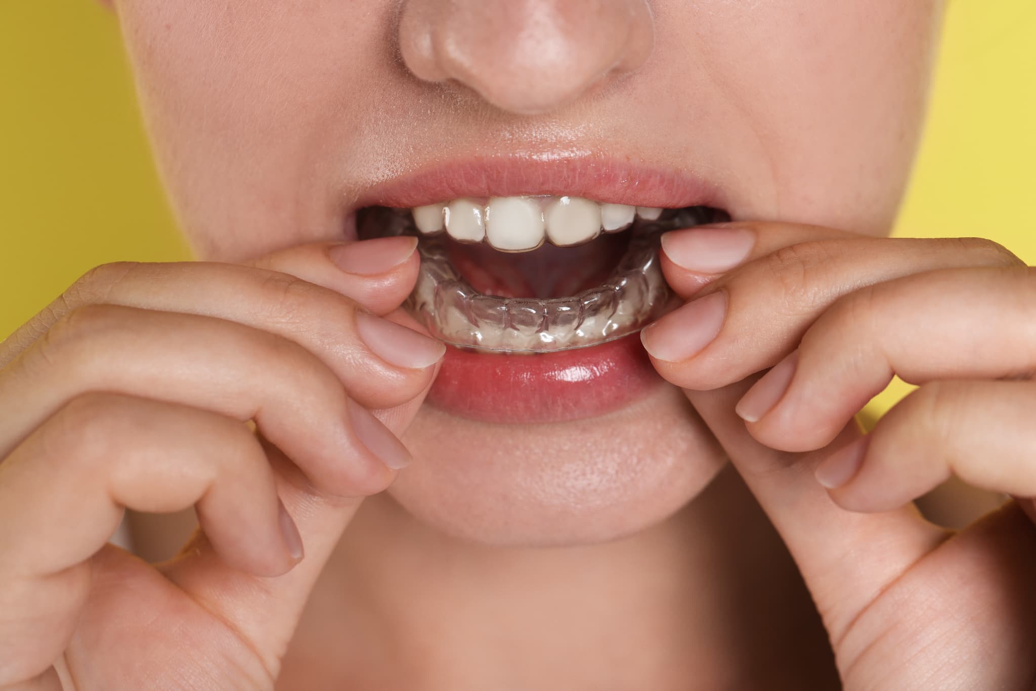 インビザラインのマウスピースを装着しようとしているイメージ