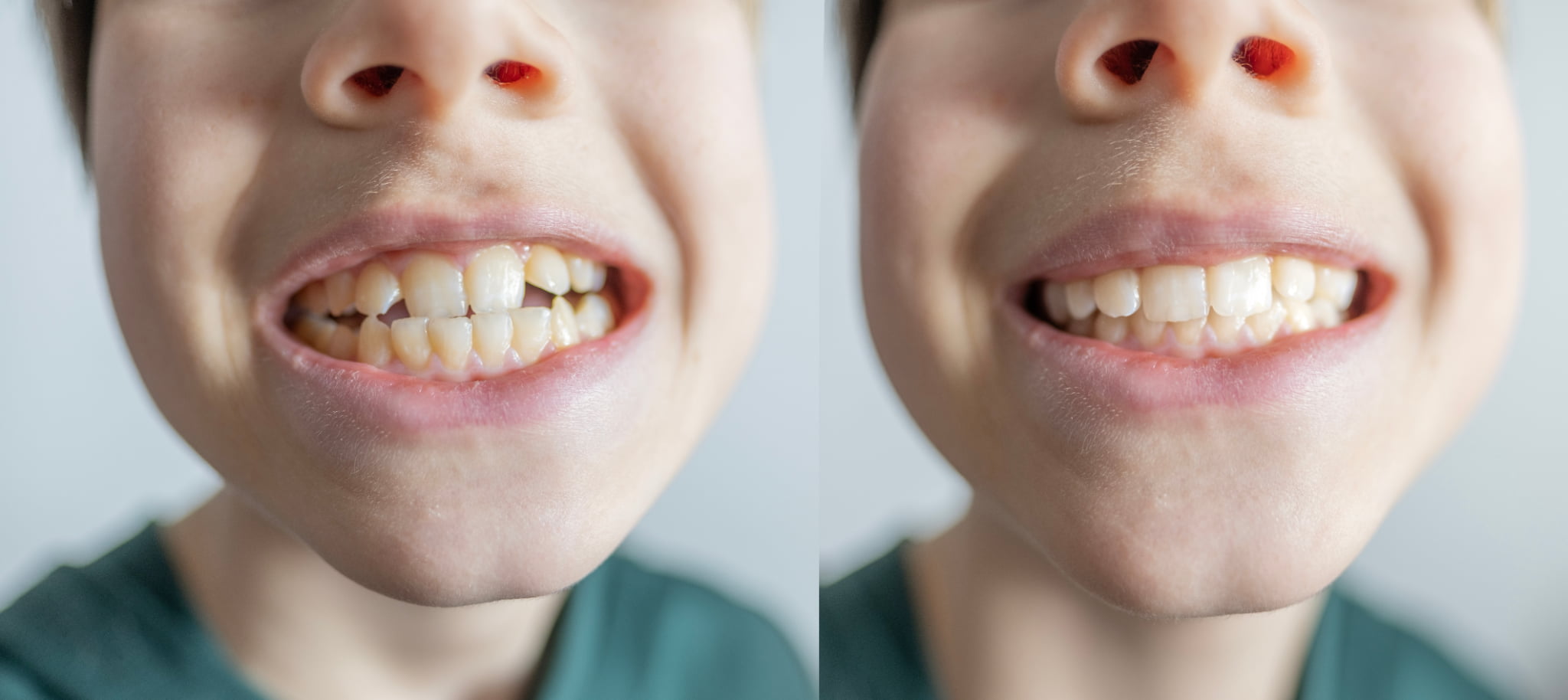 小児矯正をした前後のイメージ